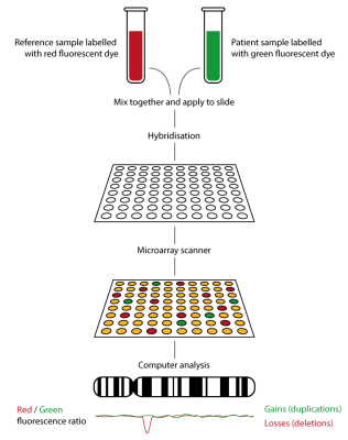 Ứng dụng Microarray CGH trong chẩn đoán